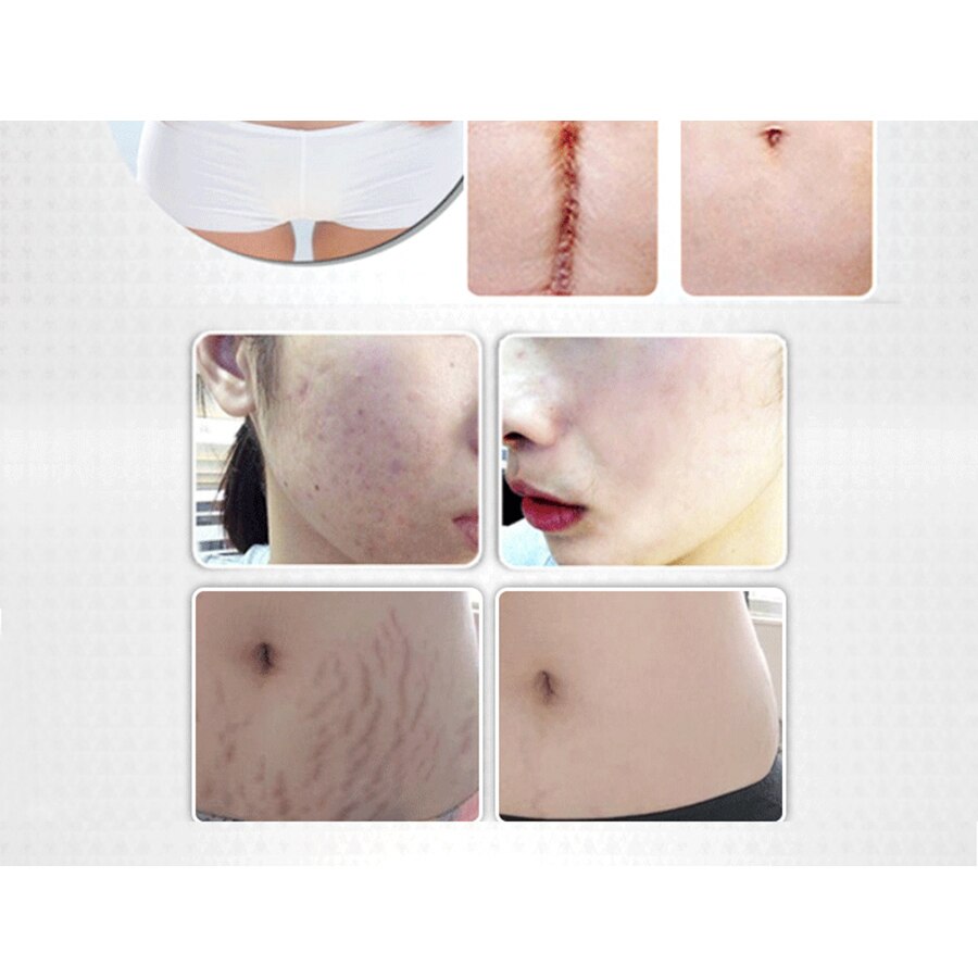 Essential Massage Oil Scar Removal Lavender Repair Essence For Pregnant Women Hyaluronic Acid Serum Oil Essential Face Anti Acne